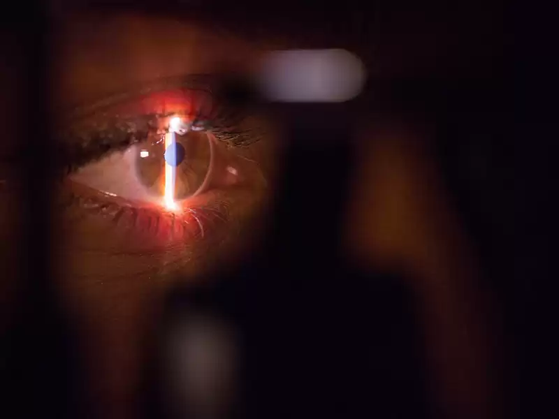 LASIK procedure