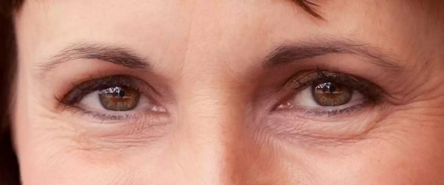 Eye Wrinkles